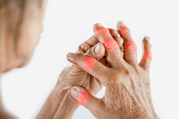 Arthrose des doigts : Diagnostic et traitements - Dr Roure
